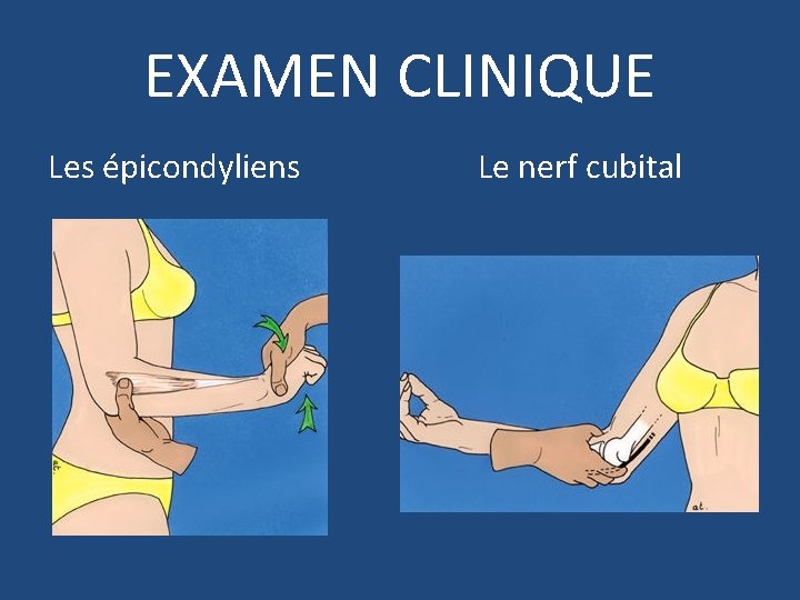 EXAMEN CLINIQUE Les épicondyliens Le nerf cubital 