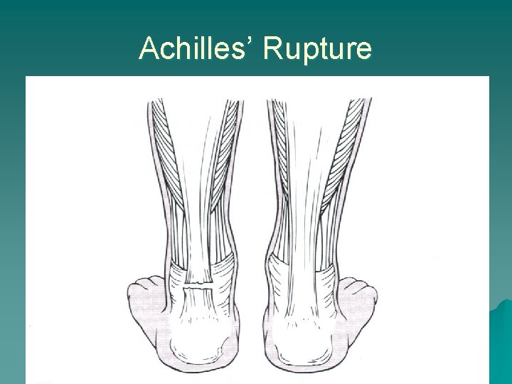 Achilles’ Rupture 