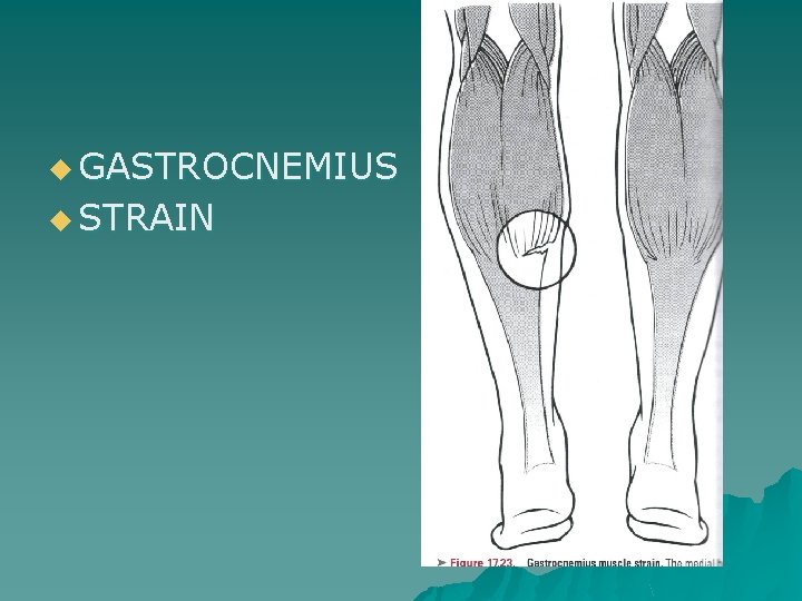 u GASTROCNEMIUS u STRAIN 