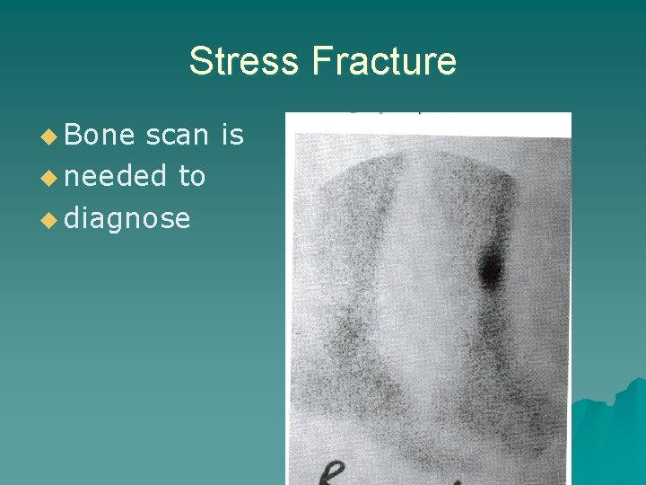 Stress Fracture u Bone scan is u needed to u diagnose 
