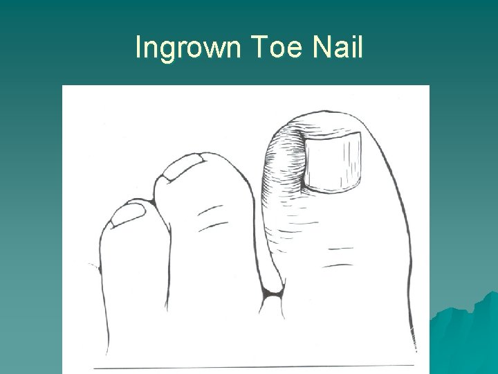 Ingrown Toe Nail 