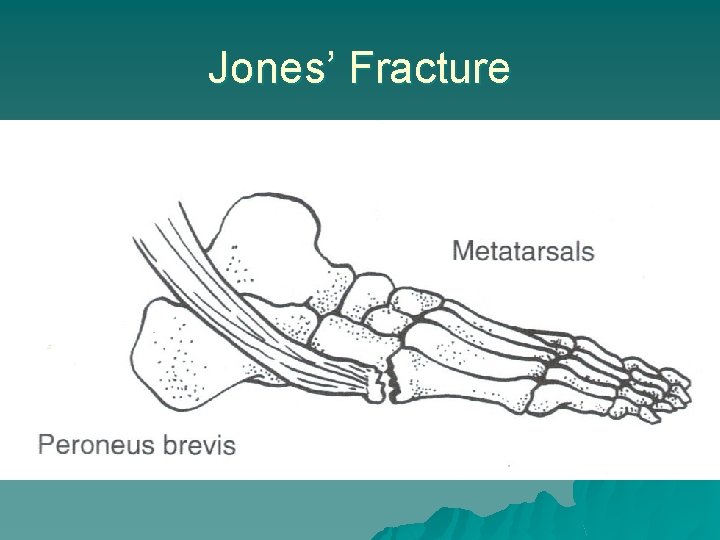 Jones’ Fracture 