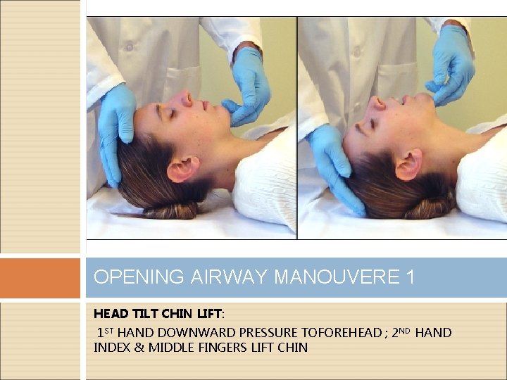 OPENING AIRWAY MANOUVERE 1 HEAD TILT CHIN LIFT: 1 ST HAND DOWNWARD PRESSURE TOFOREHEAD