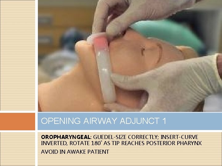 OPENING AIRWAY ADJUNCT 1 OROPHARYNGEAL: GUEDEL-SIZE CORRECTLY; INSERT-CURVE INVERTED, ROTATE 180˚ AS TIP REACHES