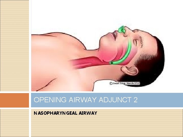 OPENING AIRWAY ADJUNCT 2 NASOPHARYNGEAL AIRWAY 