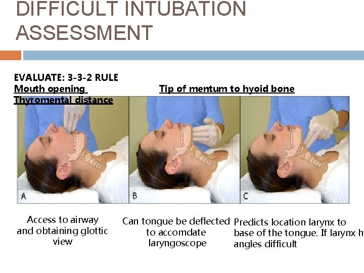 DIFFICULT INTUBATION ASSESSMENT EVALUATE: 3 -3 -2 RULE Mouth opening Thyromental distance Access to