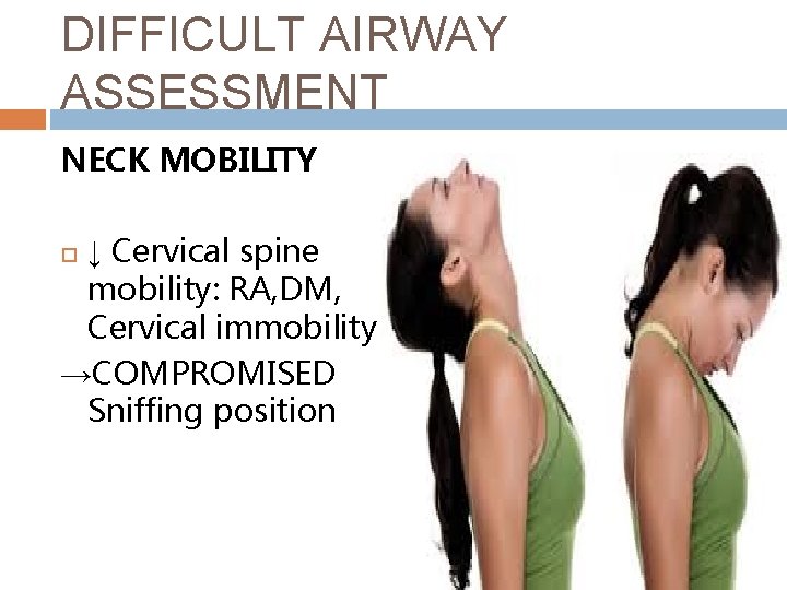 DIFFICULT AIRWAY ASSESSMENT NECK MOBILITY ↓ Cervical spine mobility: RA, DM, Cervical immobility →COMPROMISED
