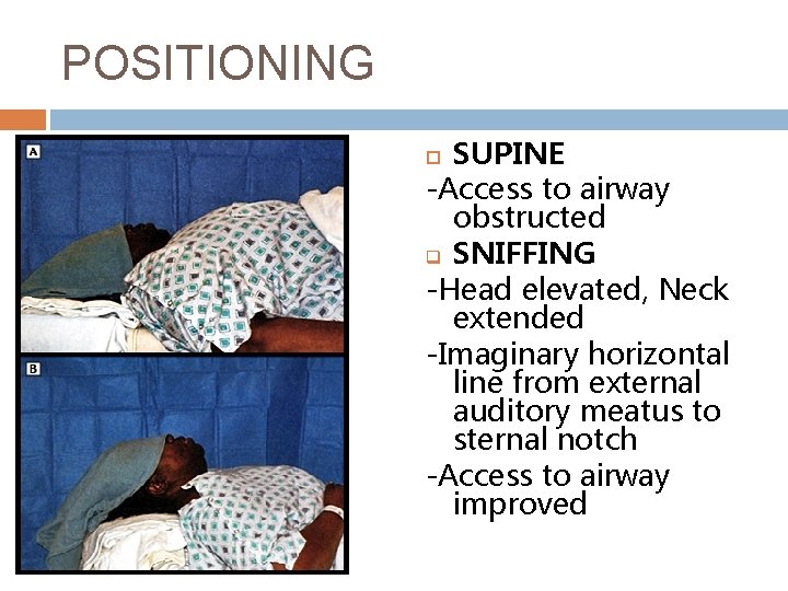 POSITIONING SUPINE -Access to airway obstructed q SNIFFING -Head elevated, Neck extended -Imaginary horizontal