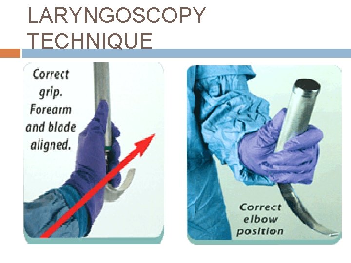 LARYNGOSCOPY TECHNIQUE 
