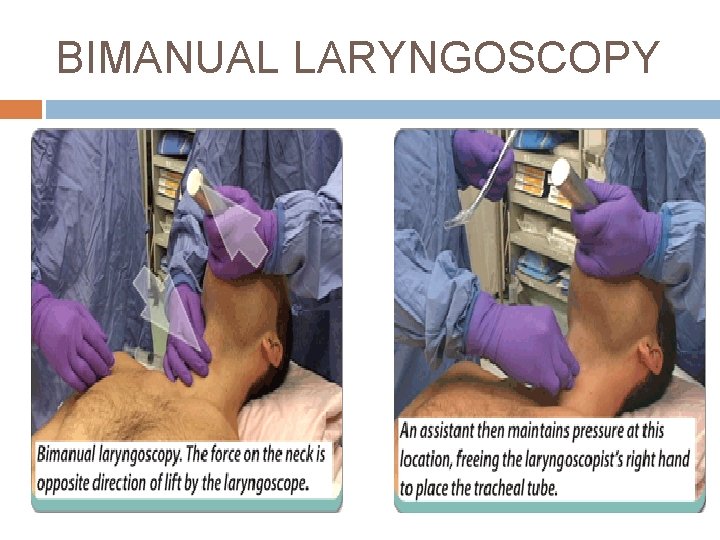 BIMANUAL LARYNGOSCOPY 