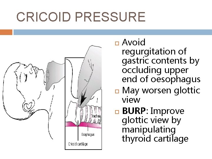 CRICOID PRESSURE Avoid regurgitation of gastric contents by occluding upper end of oesophagus May