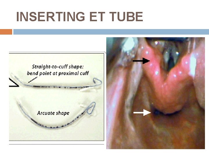 INSERTING ET TUBE 