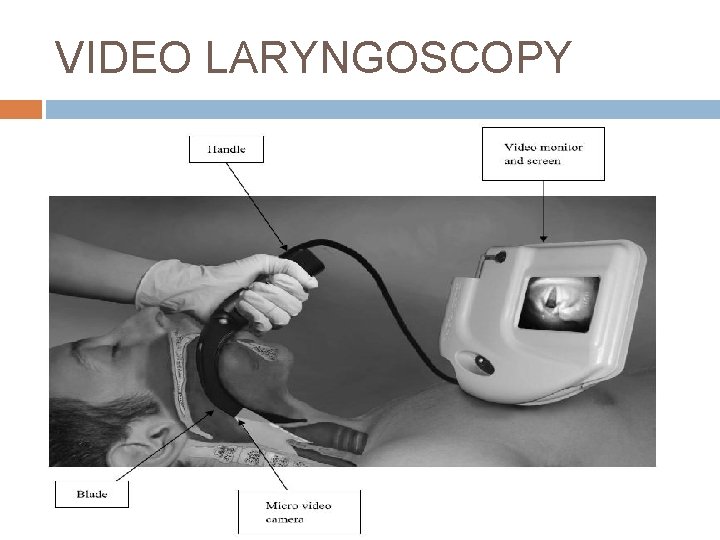 VIDEO LARYNGOSCOPY 