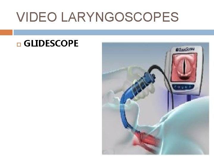 VIDEO LARYNGOSCOPES GLIDESCOPE 