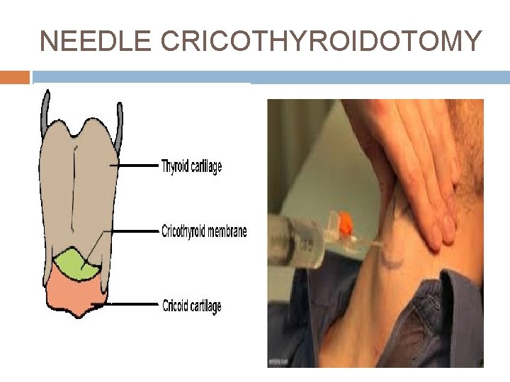 NEEDLE CRICOTHYROIDOTOMY 