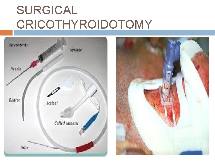 SURGICAL CRICOTHYROIDOTOMY 