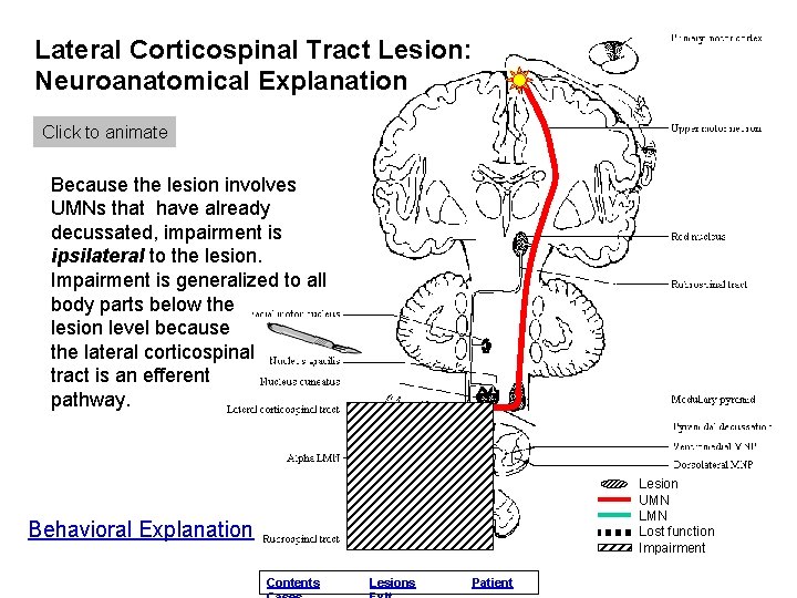 Lateral Corticospinal Tract Lesion: Neuroanatomical Explanation Click to animate Because the lesion involves UMNs
