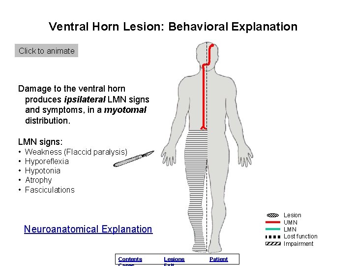 Ventral Horn Lesion: Behavioral Explanation Click to animate Damage to the ventral horn produces
