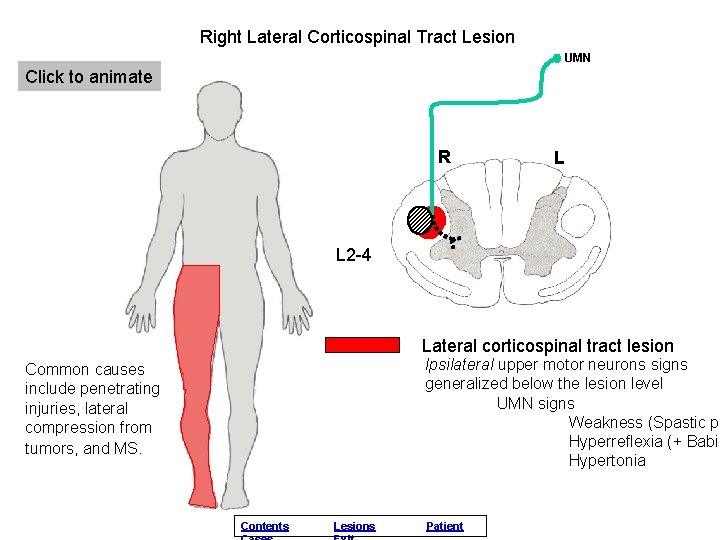 Right Lateral Corticospinal Tract Lesion UMN Click to animate R L L 2 -4