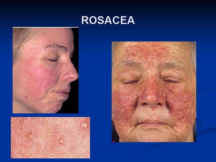 ROSACEA 