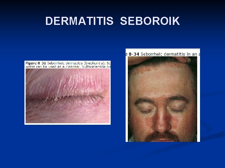 DERMATITIS SEBOROIK 