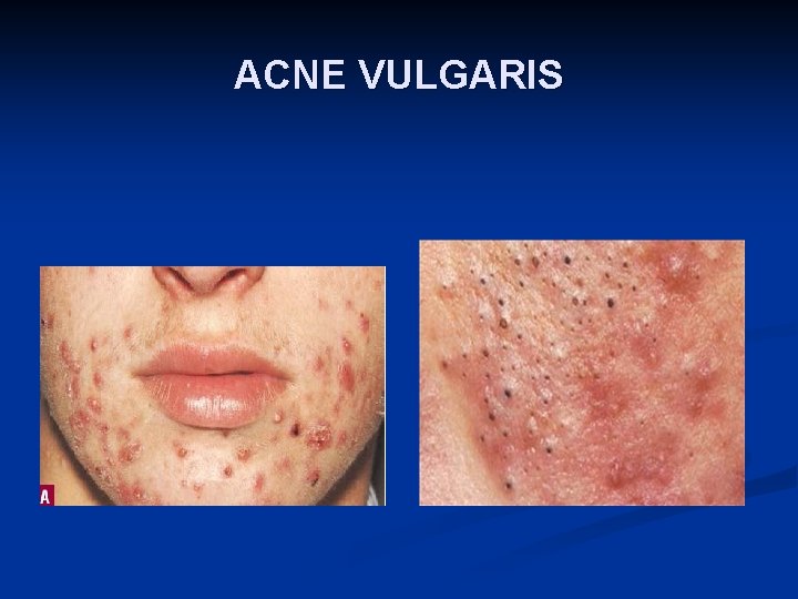 ACNE VULGARIS 