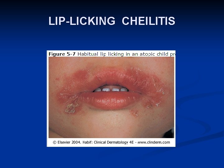 LIP-LICKING CHEILITIS 