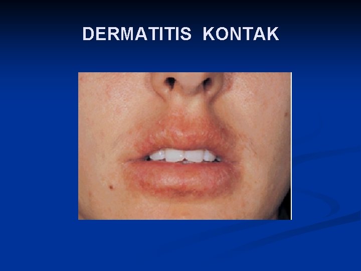 DERMATITIS KONTAK 