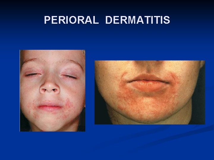 PERIORAL DERMATITIS 