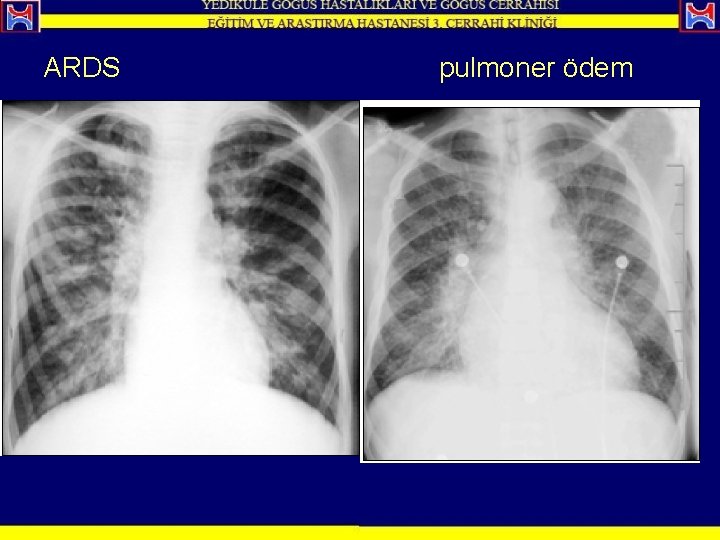 ARDS pulmoner ödem 