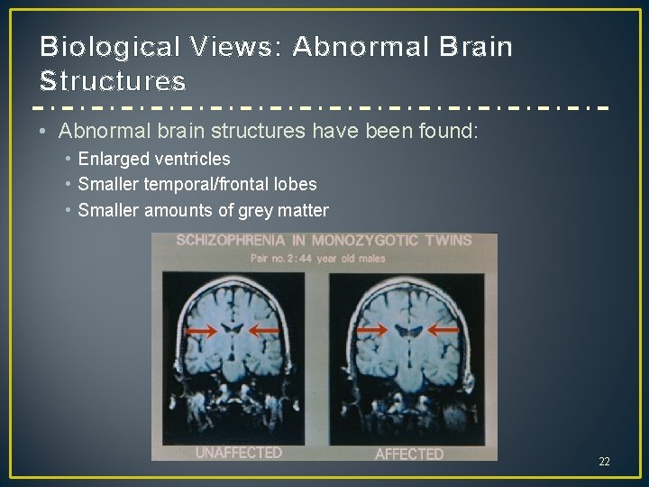 Biological Views: Abnormal Brain Structures • Abnormal brain structures have been found: • Enlarged