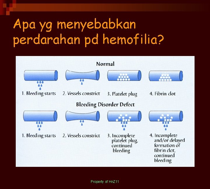 Apa yg menyebabkan perdarahan pd hemofilia? Property of Hn. Z 11 