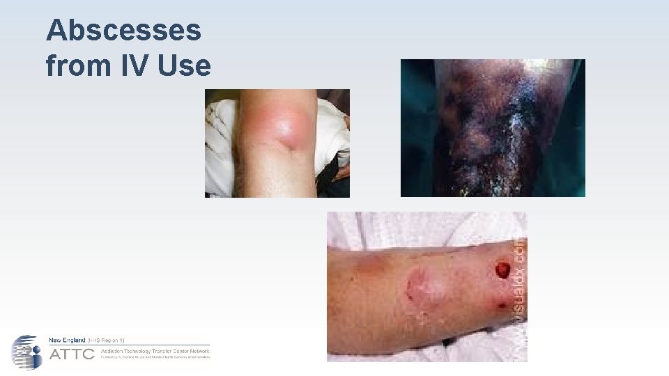 Abscesses from IV Use 