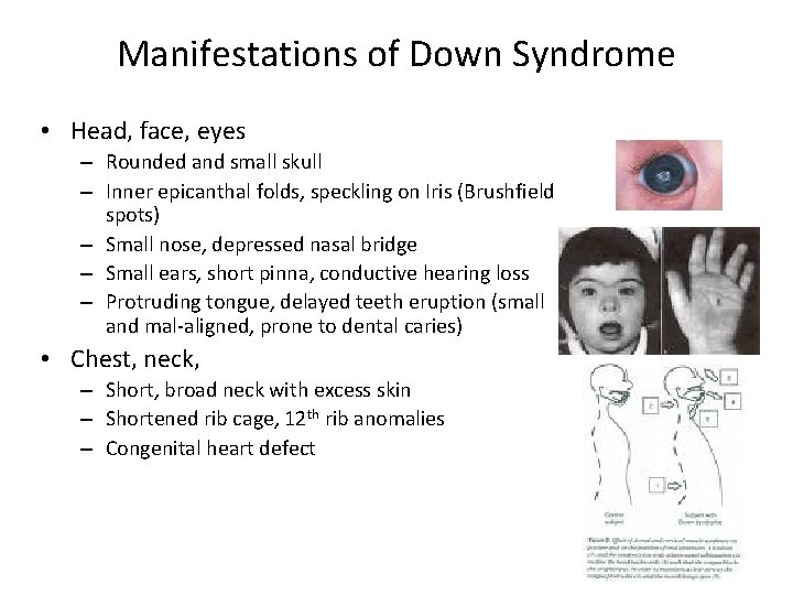 Manifestations of Down Syndrome • Head, face, eyes – Rounded and small skull –