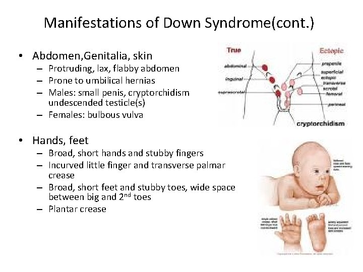 Manifestations of Down Syndrome(cont. ) • Abdomen, Genitalia, skin – Protruding, lax, flabby abdomen