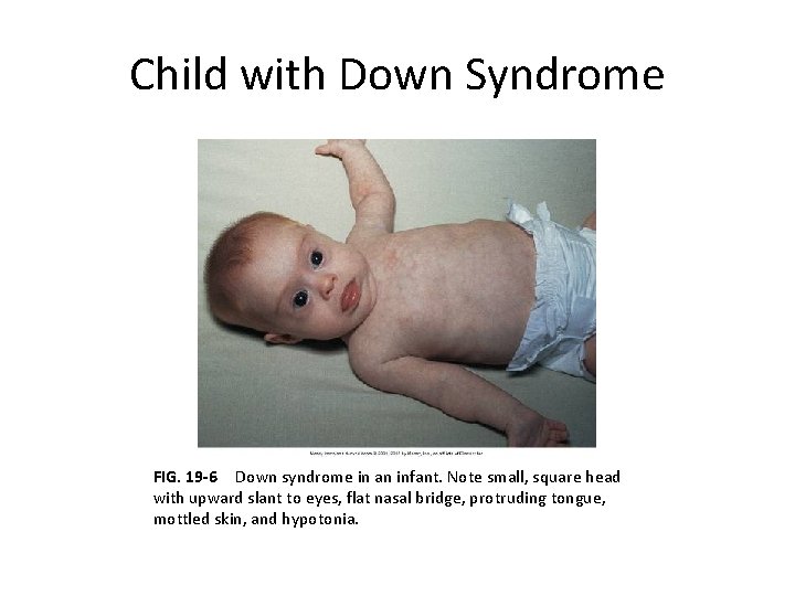 Child with Down Syndrome FIG. 19 -6  Down syndrome in an infant. Note small, square