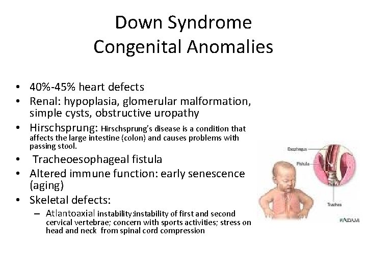 Down Syndrome Congenital Anomalies • 40%-45% heart defects • Renal: hypoplasia, glomerular malformation, simple