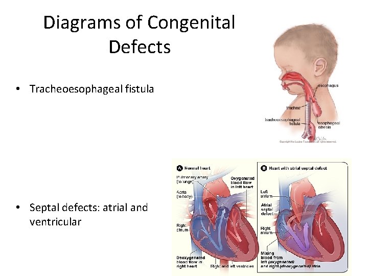 Diagrams of Congenital Defects • Tracheoesophageal fistula • Septal defects: atrial and ventricular 