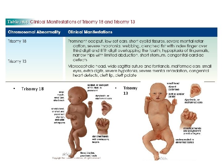  • Trisomy 18 • Trisomy 13 