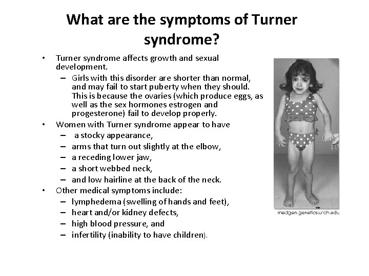 What are the symptoms of Turner syndrome? • • • Turner syndrome affects growth