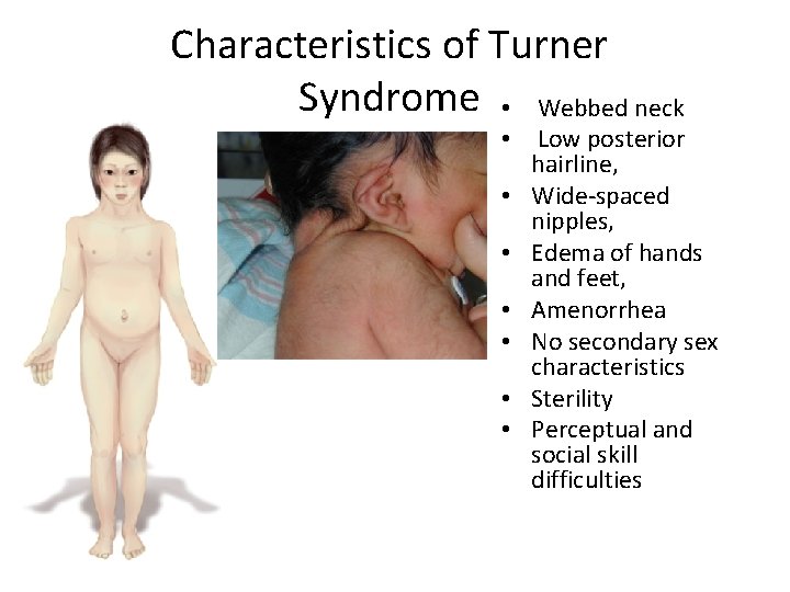 Characteristics of Turner Syndrome • Webbed neck • Low posterior hairline, • Wide-spaced nipples,