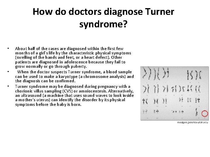 How do doctors diagnose Turner syndrome? • • • About half of the cases