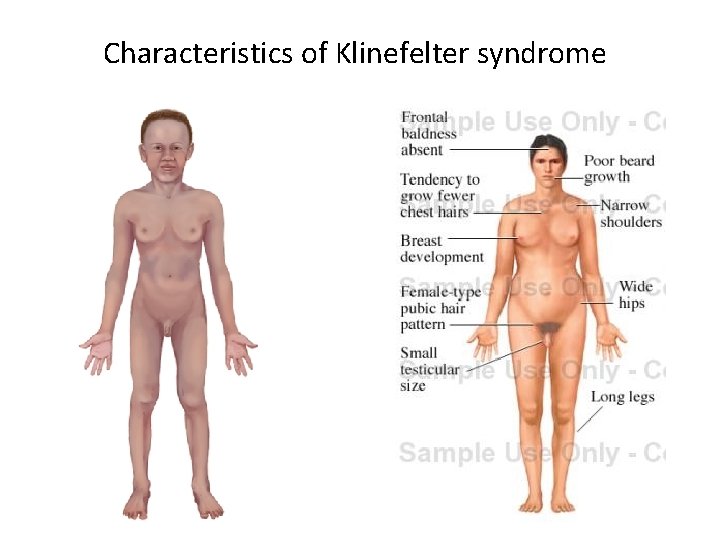 Characteristics of Klinefelter syndrome 