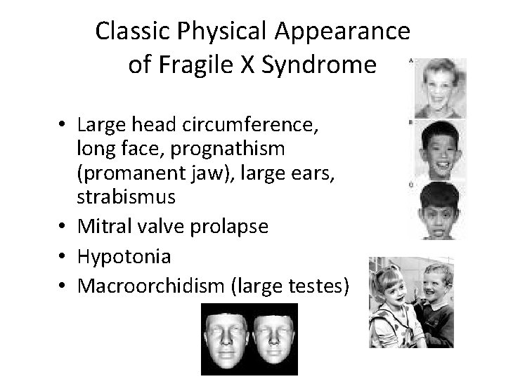 Classic Physical Appearance of Fragile X Syndrome • Large head circumference, long face, prognathism