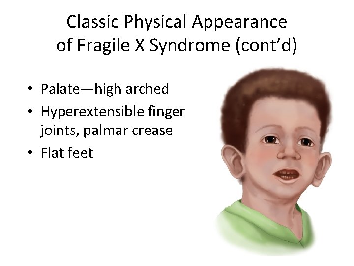 Classic Physical Appearance of Fragile X Syndrome (cont’d) • Palate—high arched • Hyperextensible finger