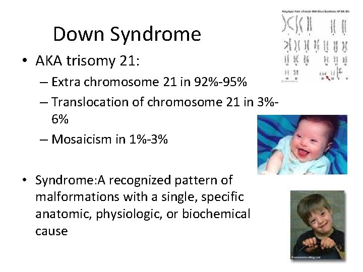 Down Syndrome • AKA trisomy 21: – Extra chromosome 21 in 92%-95% – Translocation