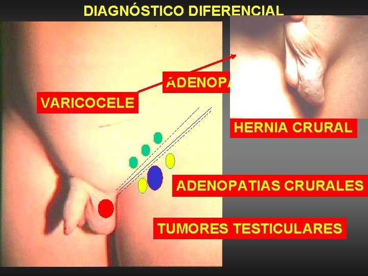 DIAGNÓSTICO DIFERENCIAL ADENOPATIAS IGUINALES VARICOCELE HERNIA CRURAL ADENOPATIAS CRURALES TUMORES TESTICULARES 