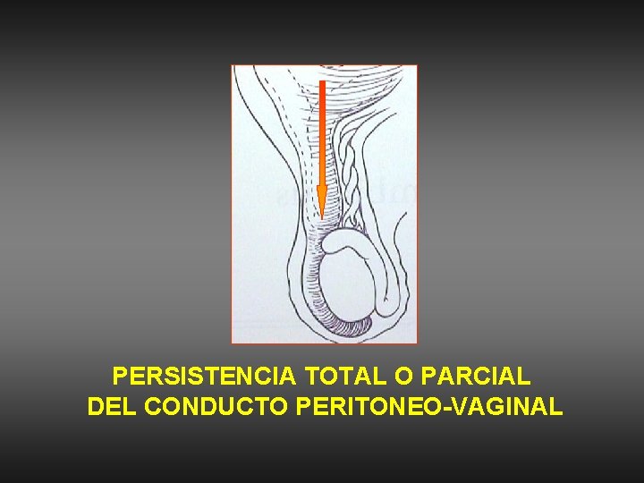 PERSISTENCIA TOTAL O PARCIAL DEL CONDUCTO PERITONEO-VAGINAL 