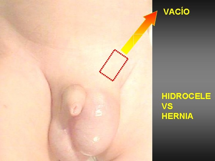 VACÍO HIDROCELE VS HERNIA 