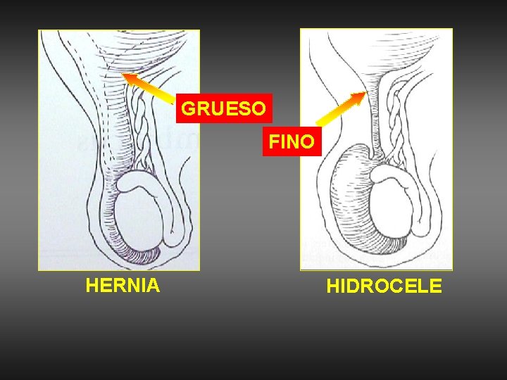 GRUESO FINO HERNIA HIDROCELE 
